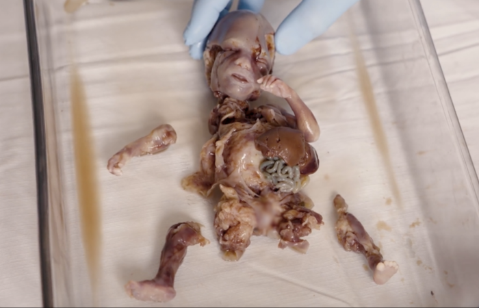 Image of aborted baby, killed by dismemberment abortion.